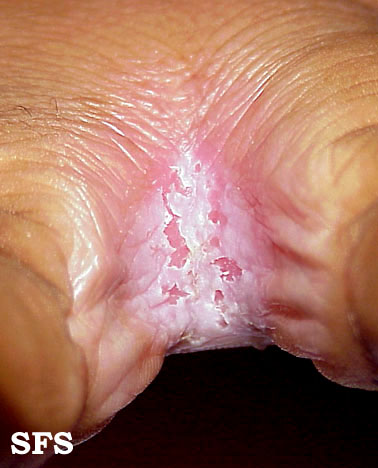 File:Candidiasis (Dermatology Atlas 5).jpg