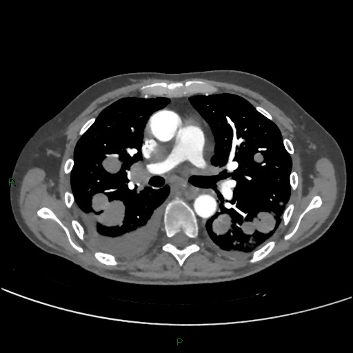 Cannonball metastases (Radiopaedia 82110-96150 Axial C+ CTPA 151).jpg