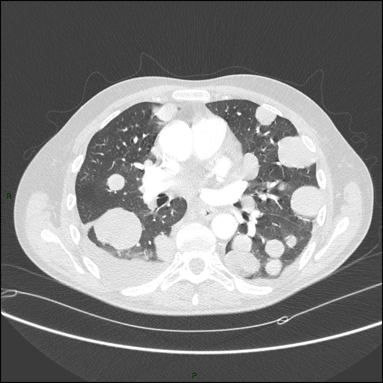 Cannonball metastases (Radiopaedia 82110-96150 Axial lung window 101).jpg