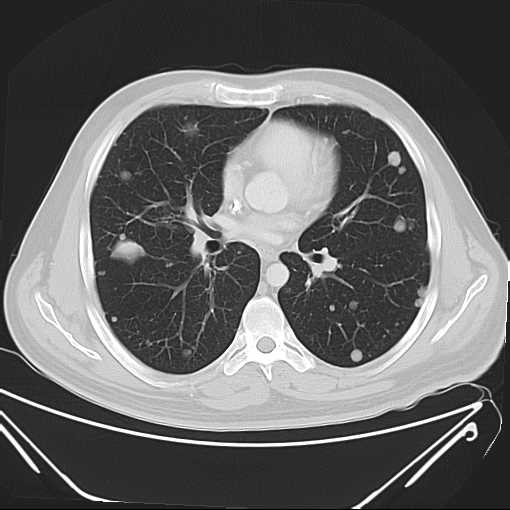 File:Cannonball pulmonary metastases (Radiopaedia 67684-77101 Axial lung window 13).jpg