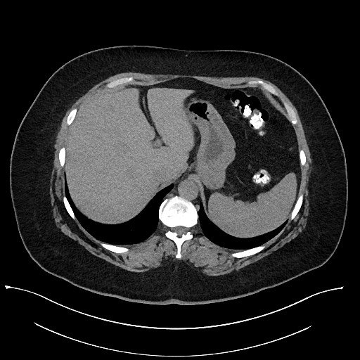 File:Carcinoid tumor - terminal ileum (Radiopaedia 60931-68740 Axial non-contrast 15).jpg