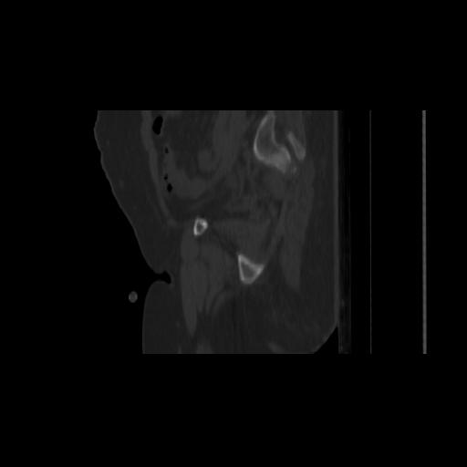 Carcinoma cervix- brachytherapy applicator (Radiopaedia 33135-34173 Sagittal bone window 42).jpg