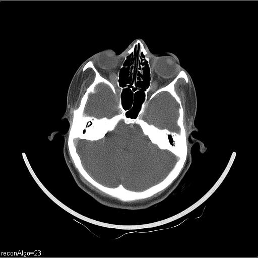 Carcinoma of the maxillary antrum (Radiopaedia 53805-59888 Axial C+ delayed 63).jpg