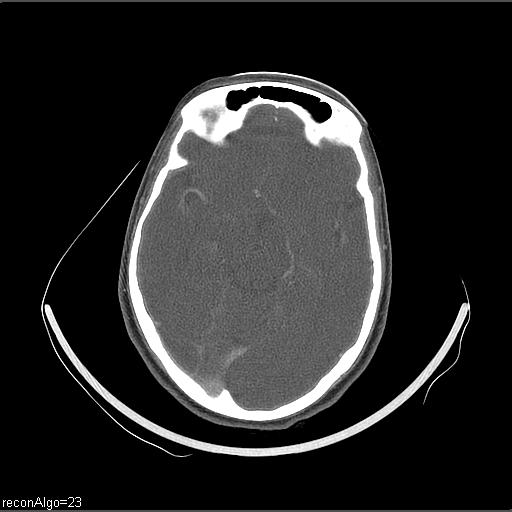 File:Carcinoma of the maxillary antrum (Radiopaedia 53805-59888 Axial C+ delayed 74).jpg