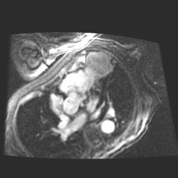 File:Cardiac fibroma (Radiopaedia 38974-41150 4 chamber FGRET 11).jpg