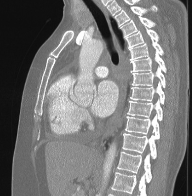 Cardiac sarcoidosis (Radiopaedia 74548-85534 Sagittal lung window 47).jpg