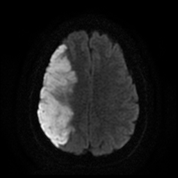 File:Carotid arterial dissection with acute cerebral infarction (Radiopaedia 26636-26784 Axial DWI 15).jpg