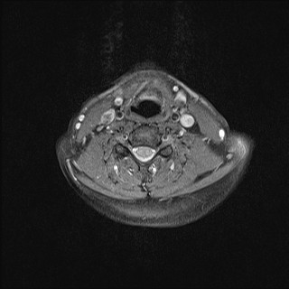 File:Carotid artery dissection (Radiopaedia 28441-28689 Axial T1 fat sat 18).jpg