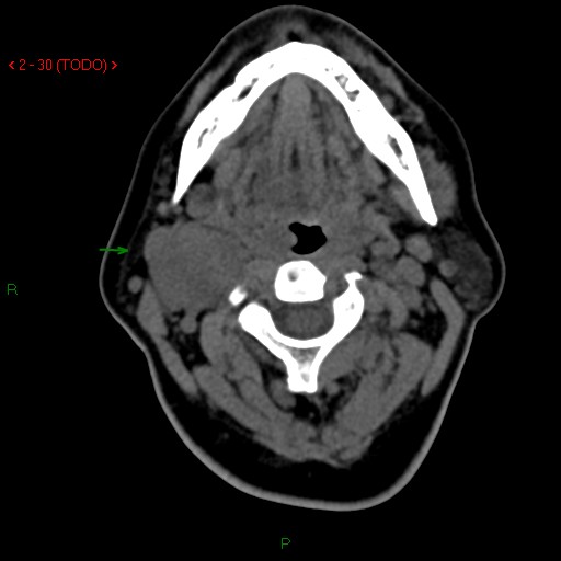File:Carotid body tumor (Radiopaedia 20564-20462 Axial non-contrast 1).jpg