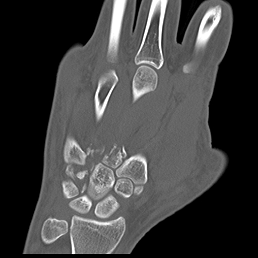 File:Carpo-metacarpal fracture-dislocations with hamatum split fracture (Radiopaedia 18482-18343 Coronal bone window 9).jpg