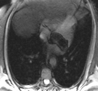 File:Caseous calcification of the mitral valve annulus (Radiopaedia 47717-52411 Axial Gradient Echo 1).jpg
