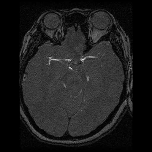 Cavernoma, DVA and right ICA aneurysm (Radiopaedia 33890-35072 E 47).png
