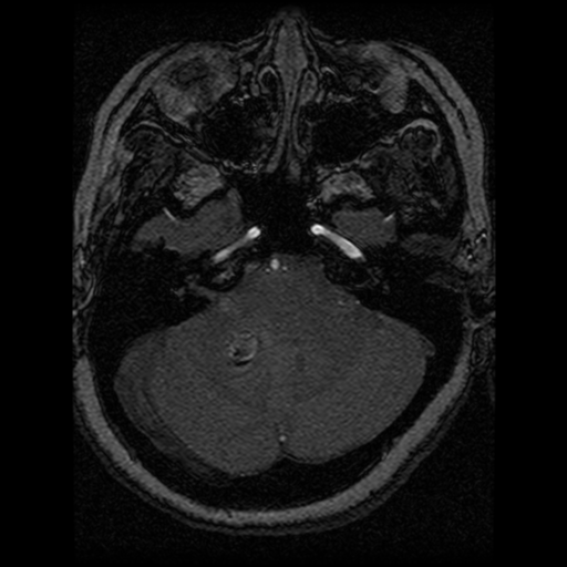 Cavernoma, DVA and right ICA aneurysm (Radiopaedia 33890-35072 E 81).png