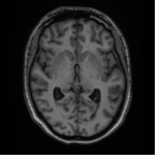 Cavernoma with bleed - midbrain (Radiopaedia 54546-60774 Axial T1 20).png