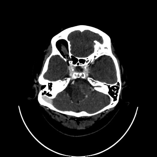 Cavernoma with developmental venous anomaly (Radiopaedia 22470-22506 C 26).jpg