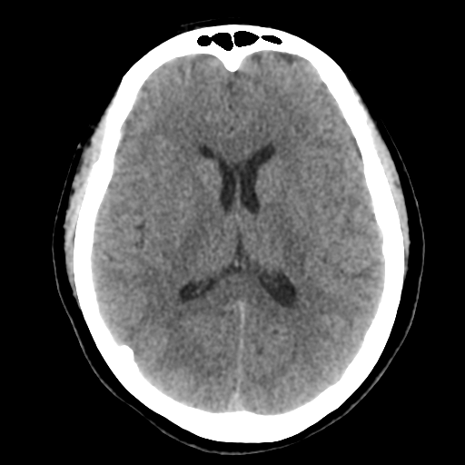 Cavernoma with hemorrhage (Radiopaedia 70755-80931 Axial non-contrast 30).png