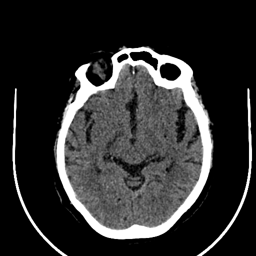 Cavernous hemangioma of the cerebellar falx (Radiopaedia 73025-83723 Axial non-contrast 60).jpg