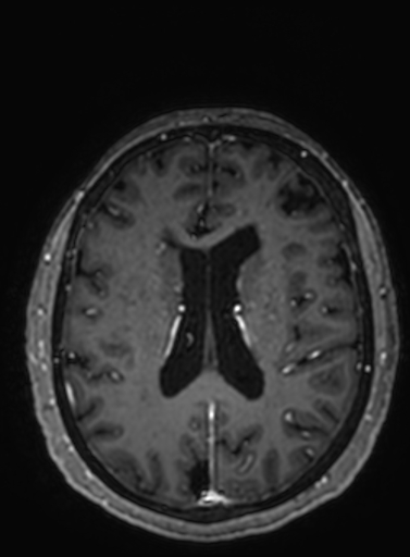 File:Cavernous hemangioma of the cerebellar falx (Radiopaedia 73025-83724 Axial T1 C+ 133).jpg