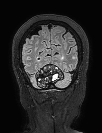 Cavernous hemangioma of the cerebellar falx (Radiopaedia 73025-83724 Coronal FLAIR 304).jpg