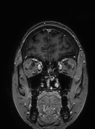 Cavernous hemangioma of the cerebellar falx (Radiopaedia 73025-83724 Coronal T1 C+ 69).jpg