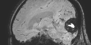 File:Cavernous hemangioma of the cerebellar falx (Radiopaedia 73025-83724 Sagittal BOLD 117).jpg