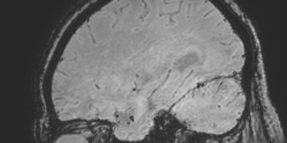 Cavernous hemangioma of the cerebellar falx (Radiopaedia 73025-83724 Sagittal BOLD 56).jpg