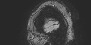 Cavernous hemangioma of the cerebellar falx (Radiopaedia 73025-83724 Sagittal BOLD 6).jpg