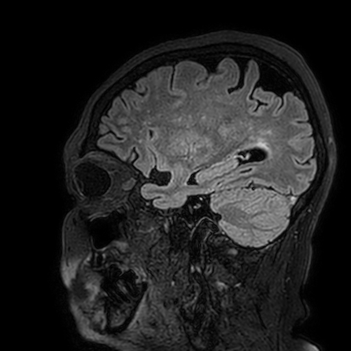Cavernous hemangioma of the cerebellar falx (Radiopaedia 73025-83724 Sagittal FLAIR 159).jpg