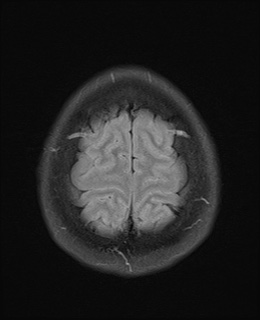 File:Cavernous sinus meningioma (Radiopaedia 63682-72367 Axial FLAIR 20).jpg
