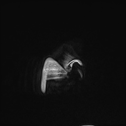 Cavernous sinus meningioma (Radiopaedia 63682-72367 Sagittal T1 C+ 11).jpg