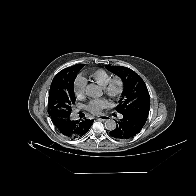 Cavitating bronchogenic carcinoma (Radiopaedia 44489-48162 Axial non-contrast 47).jpg