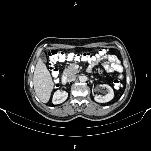 Cecal adenocarcinoma (Radiopaedia 85324-100916 B 34).jpg