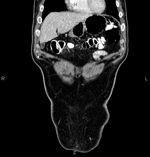 File:Cecal adenocarcinoma (Radiopaedia 85324-100916 D 10).jpg