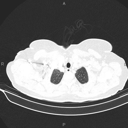 Cecal cancer (Radiopaedia 85610-101358 Axial lung window 8).jpg