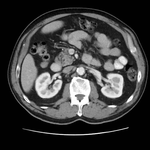 File:Cecal mass causing appendicitis (Radiopaedia 59207-66531 A 34).jpg