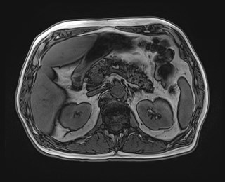 Cecal mass causing appendicitis (Radiopaedia 59207-66532 D 48).jpg