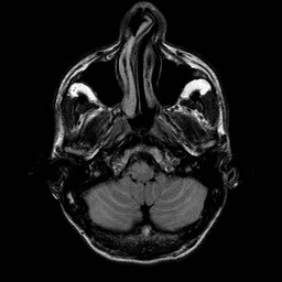 File:Central-variant posterior reversible encephalopathy syndrome (PRES) (Radiopaedia 43880-47358 Axial FLAIR 2).jpg