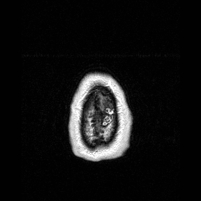File:Central-variant posterior reversible encephalopathy syndrome (PRES) (Radiopaedia 43880-47358 Axial T1 C+ 170).jpg