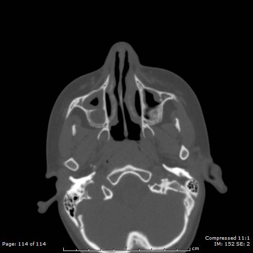 File:Central giant cell granuloma (Radiopaedia 45612-49754 Axial bone window 57).jpg