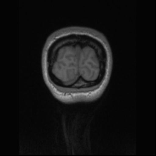 Central neurocytoma (Radiopaedia 37664-39557 Coronal T1 6).png