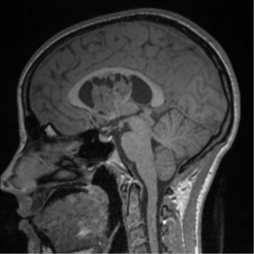 Central neurocytoma (Radiopaedia 37664-39557 Sagittal T1 50).png