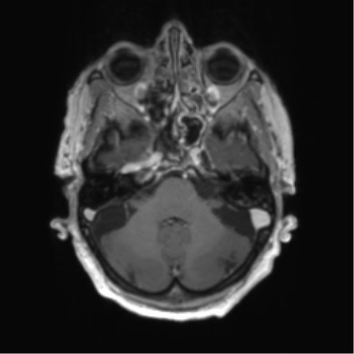 Central neurocytoma (Radiopaedia 65317-74345 Axial T1 C+ 8).png
