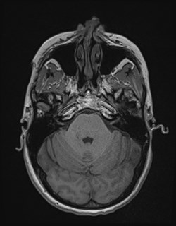 Central neurocytoma (Radiopaedia 84497-99872 Axial T1 59).jpg