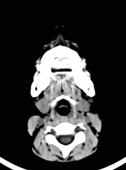 Cerebellar abscess (Radiopaedia 73727-84527 Axial non-contrast 4).jpg