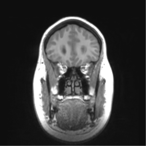 Cerebellar ependymoma complicated by post-operative subdural hematoma (Radiopaedia 83322-97736 Coronal T1 14).png