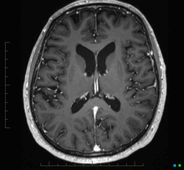 Cerebellar gangliocytoma (Radiopaedia 65377-74422 Axial T1 C+ 75).jpg