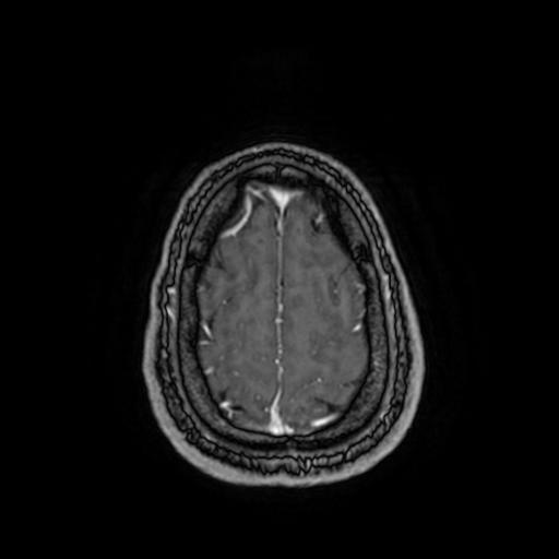 Cerebellar hemangioblastoma (Radiopaedia 88055-104622 Axial T1 C+ 151).jpg