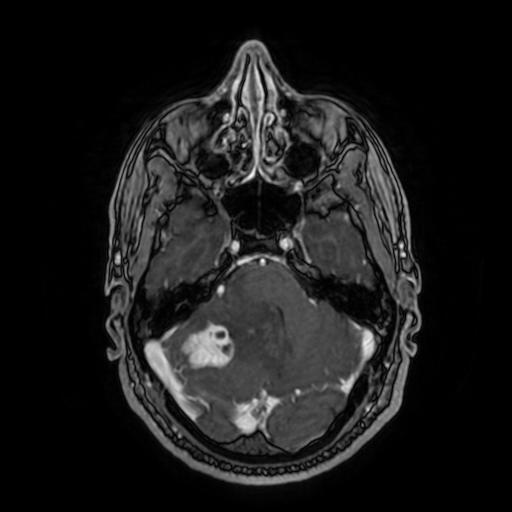 File:Cerebellar hemangioblastoma (Radiopaedia 88055-104622 Axial T1 C+ 61).jpg