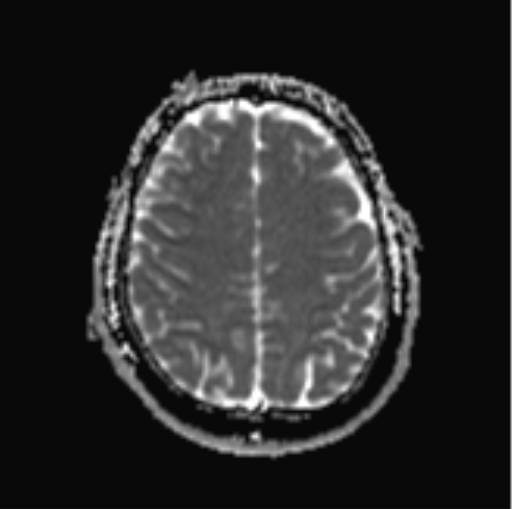 File:Cerebellar hemangioblastomas and pituitary adenoma (Radiopaedia 85490-101176 Axial ADC 26).png