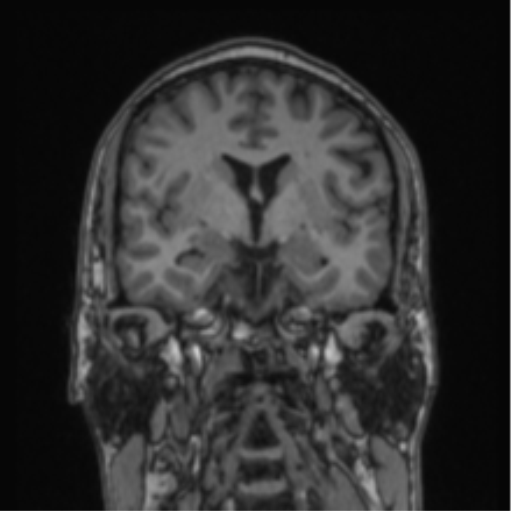File:Cerebellar hemangioblastomas and pituitary adenoma (Radiopaedia 85490-101176 Coronal T1 52).png